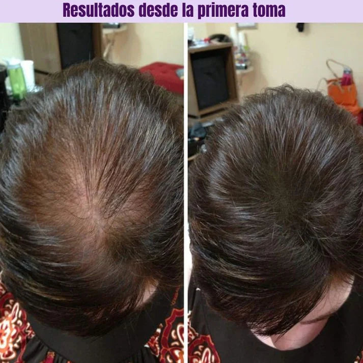 HairGrowth™ Suplemento para el crecimiento capilar avanzado